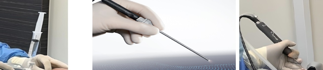 ニードルスコープ